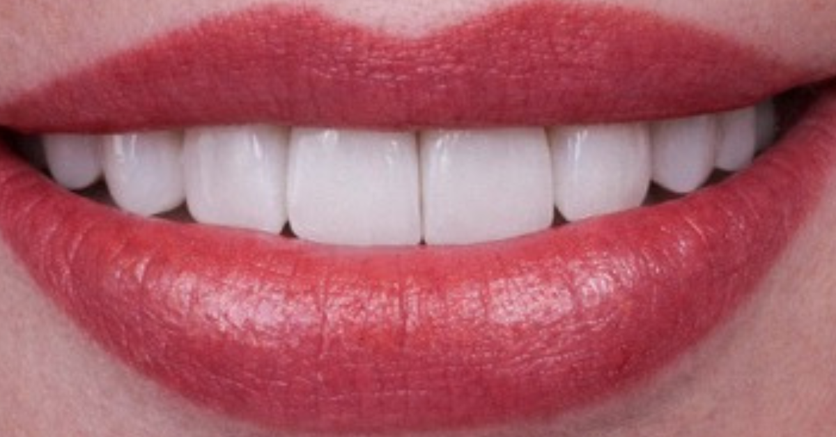 After treatment photo — After