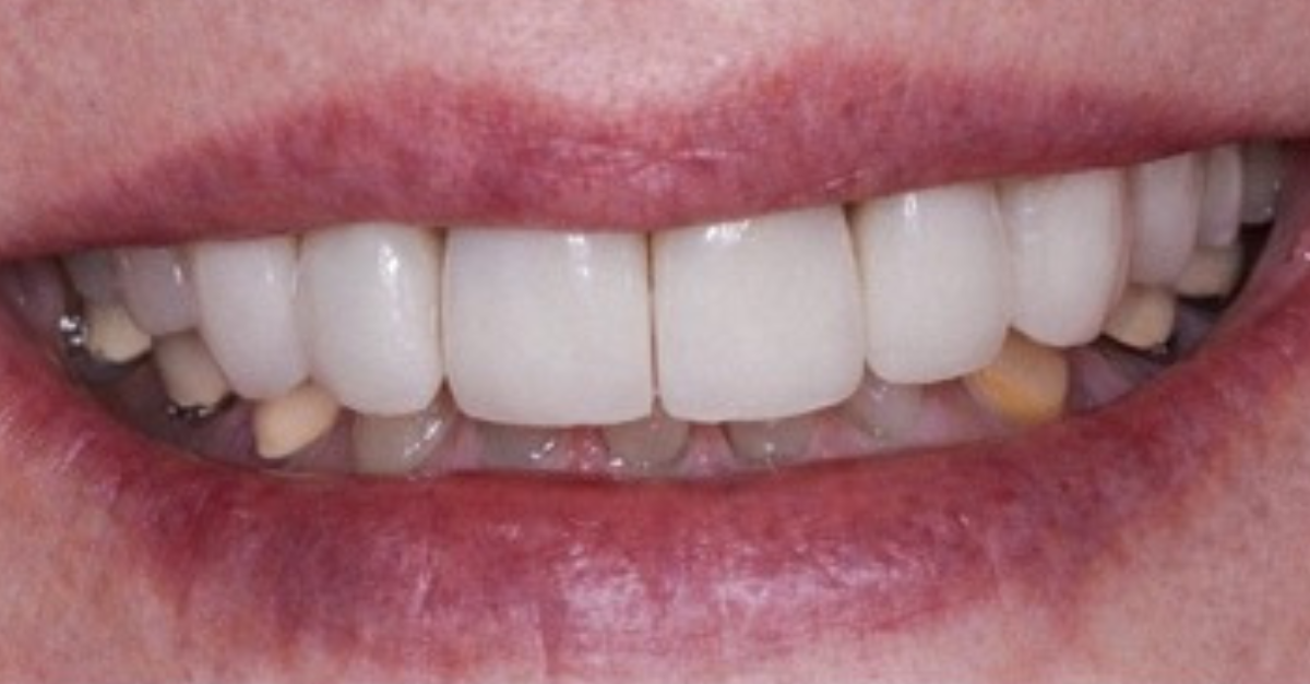 Before treatment photo — Before