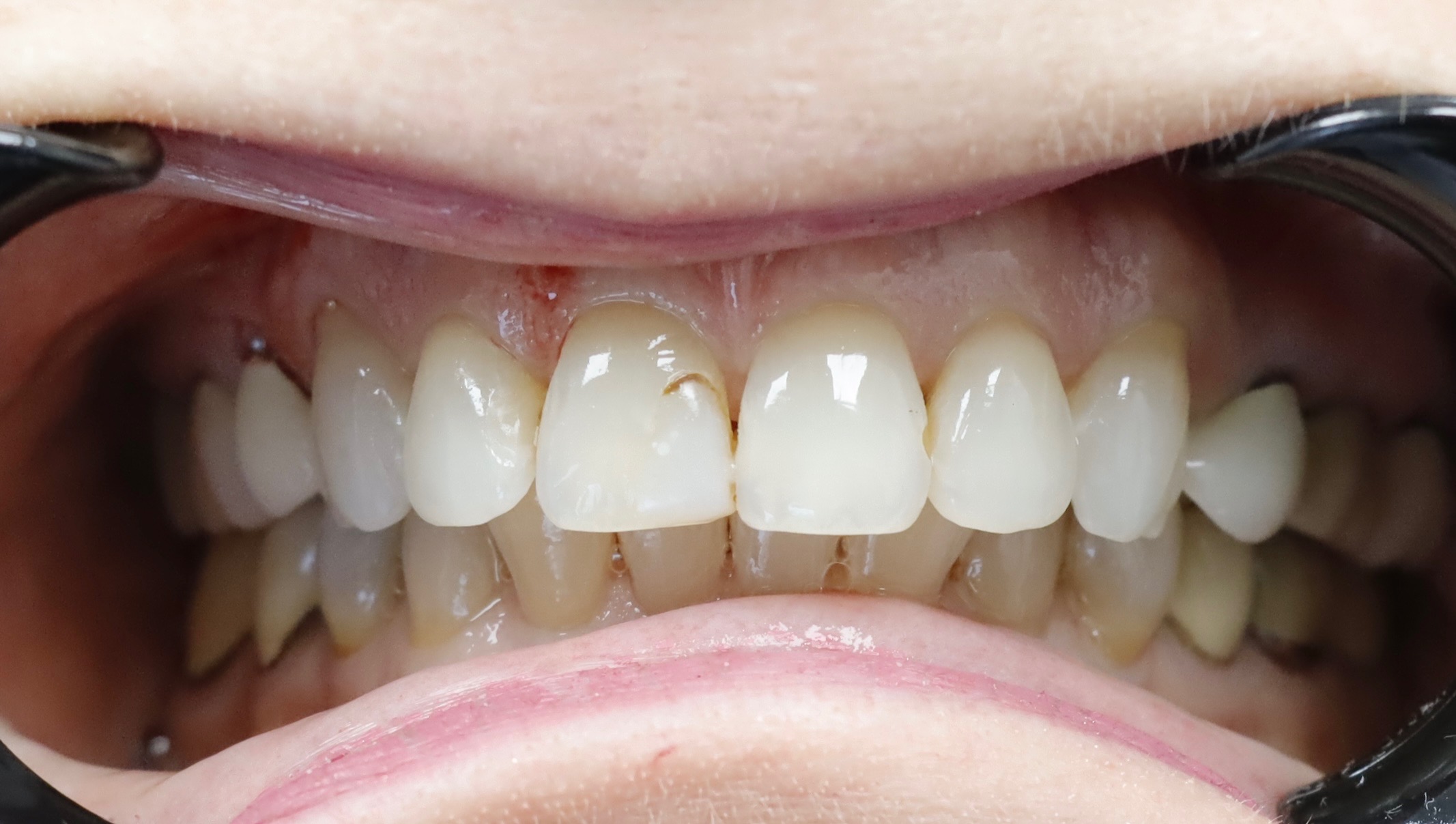 Before — case 5